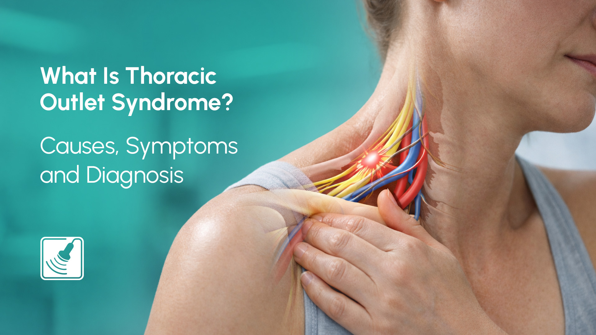 thoracic outlet syndrome