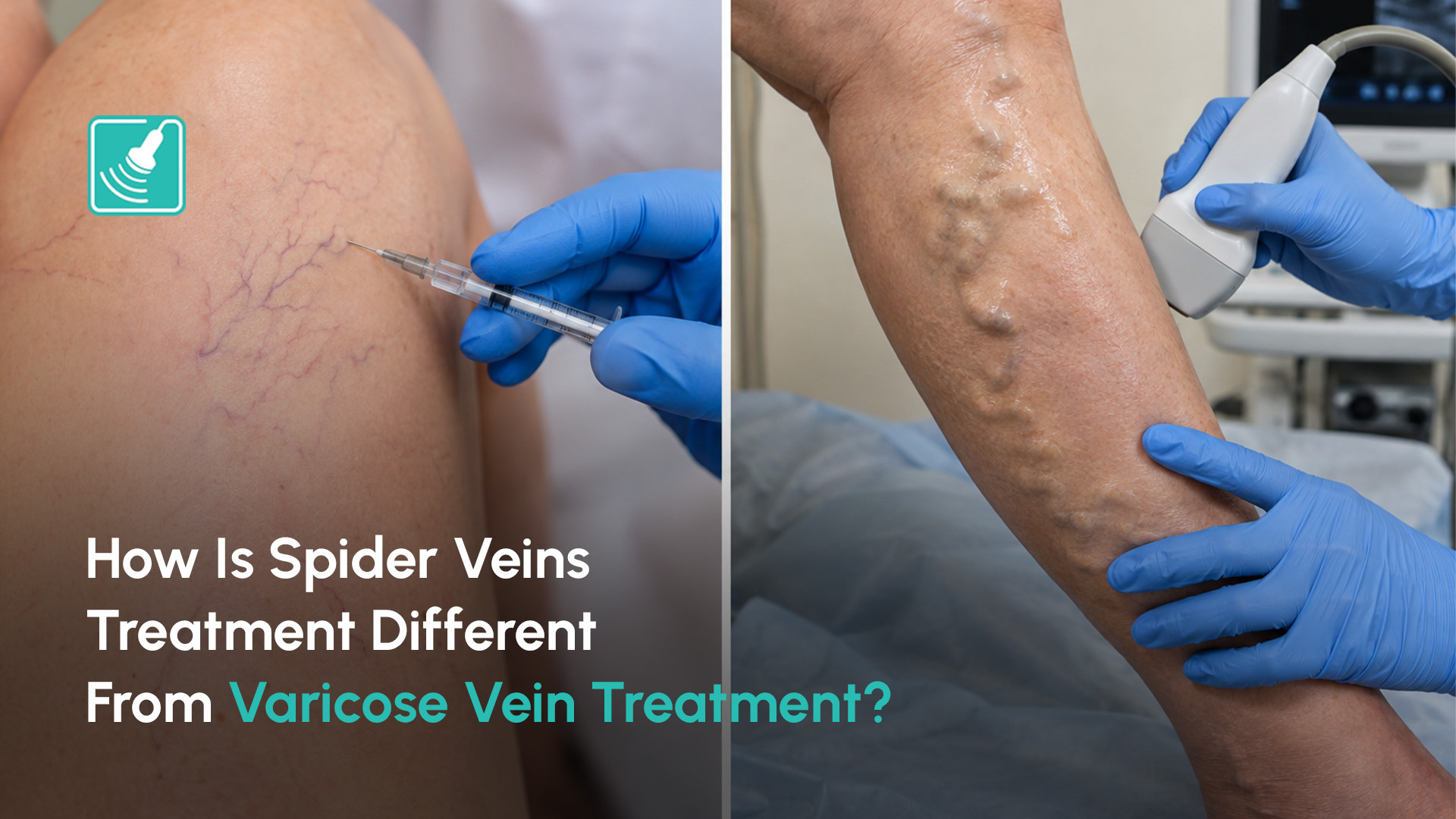Spider veins treatment vs varicose veins treatment